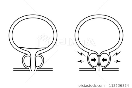 Medical illustration of benign prostatic hyperplasia, comparison of normal prostate and enlarged prostate 112536824