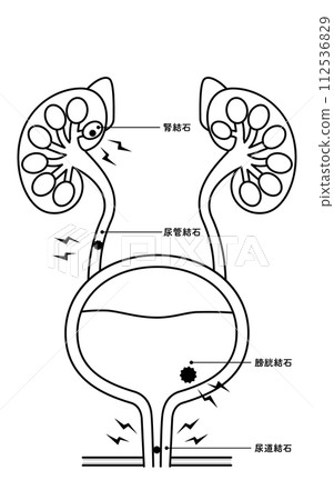 尿路結石、腎結石、輸尿管結石、膀胱結石、尿道結石的醫學插圖 112536829