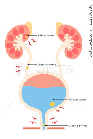 Medical illustration of urinary tract stones, kidney stones, ureteral stones, bladder stones, urethral stones Medical illustration of urinary tract stones, kidney stones, ureteral stones, bladder stones, urethral stones 112536830
