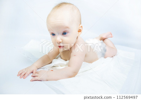 a baby with a hemangioma on his neck lies on a white background a baby with a hemangioma on his neck lies on a white background 112569497