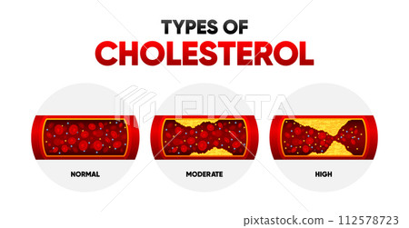 Types Cholesterol. LDL and HDl level. Arteriosclerosis, infarct, ischemia, thrombosis disease. Cholesterol in human blood vessels. Vector illustration. 112578723