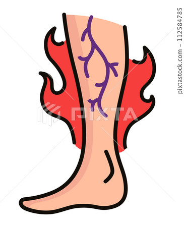Varicose treatment icon. Violation of circulatory system. Vascular disease diagnostic. Venous insufficiency medical disease. Vector illustration 112584785
