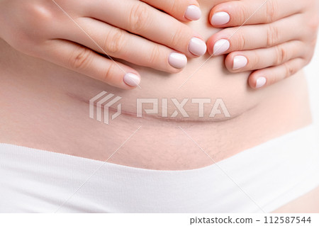 Woman belly with a big scar from a cesarean section.  112587544