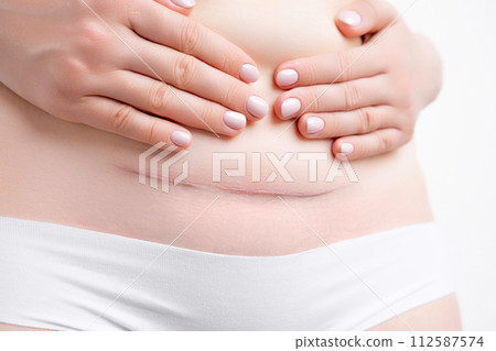 Woman holding her belly and demonstrates hypertrophic scar after c section.  112587574