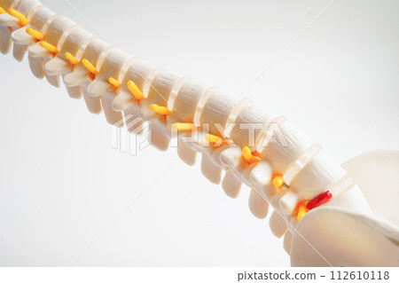 Spinal nerve and bone, Lumbar spine displaced herniated disc fragment, Model for treatment medical in the orthopedic department. Spinal nerve and bone, Lumbar spine displaced herniated disc fragment, Model for treatment medical in the orthopedic department. 112610118