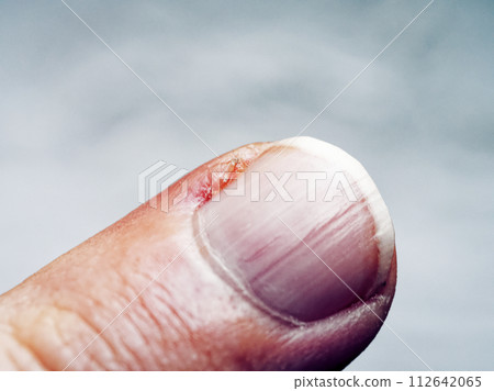 The image captures the texture and details of an injured finger. 112642065