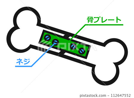 Illustration of treatment for broken bone due to accident Illustration of treatment for broken bone due to accident 112647552