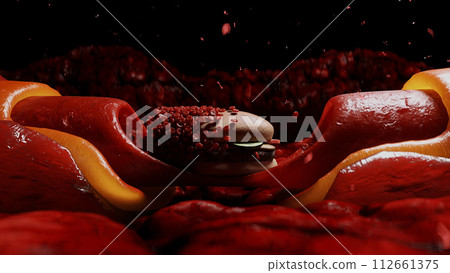 junk food. blood stream and cholesterol plaque, thrombus. health harm concept. Inside human body. junk food. blood stream and cholesterol plaque, thrombus. health harm concept. Inside human body. 112661375