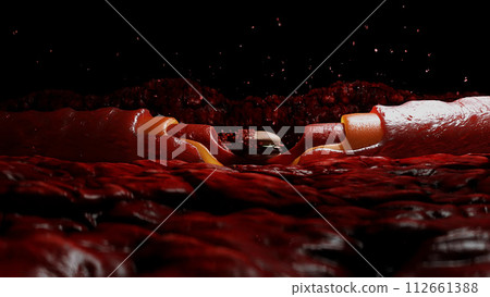 junk food. blood stream and cholesterol plaque, thrombus. health harm concept. Inside human body. junk food. blood stream and cholesterol plaque, thrombus. health harm concept. Inside human body. 112661388