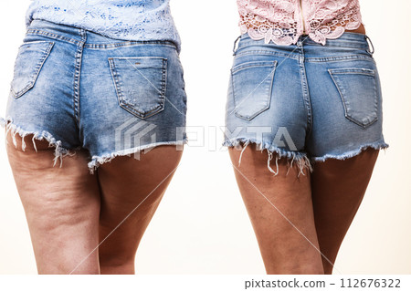 Comparison of legs with and without cellulite 112676322