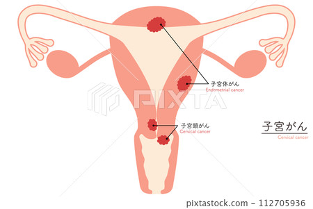 子宮癌圖解、子宮和卵巢解剖圖 子宮癌圖解、子宮和卵巢解剖圖 112705936