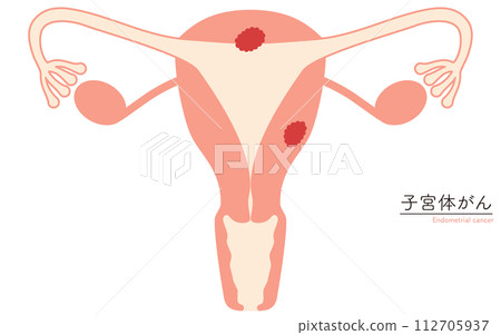 Illustrated illustration of uterine cancer, anatomical diagram of the uterus and ovaries 112705937