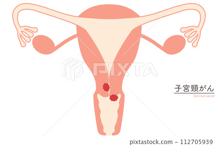 Illustrated illustration of cervical cancer, anatomical diagram of the uterus and ovaries Illustrated illustration of cervical cancer, anatomical diagram of the uterus and ovaries 112705939