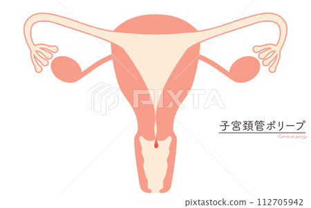 子宮頸息肉插圖、子宮和卵巢解剖圖 112705942