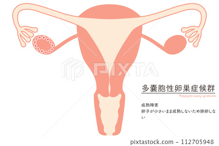 多囊性卵巢症候群（成熟障礙）插圖、子宮和卵巢解剖圖 112705948
