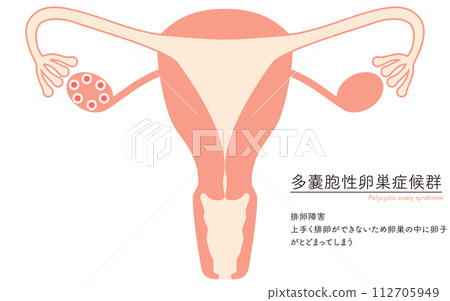 多囊性卵巢症候群(排卵障礙)插圖、子宮和卵巢解剖圖 多囊性卵巢症候群(排卵障礙)插圖、子宮和卵巢解剖圖 112705949