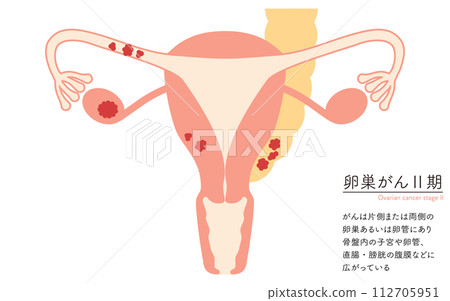 卵巢癌 II 期插圖，子宮和卵巢的解剖圖 112705951