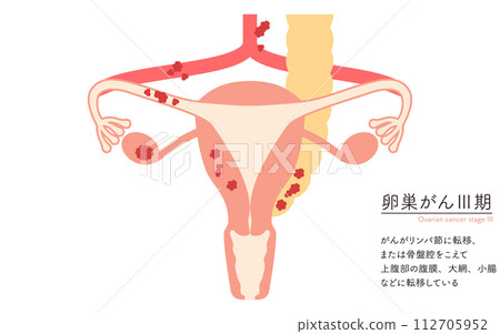 Illustrated illustration of ovarian cancer stage III, anatomical diagram of the uterus and ovaries 112705952