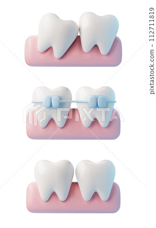 Teeth with brackets, orthodontic treatment, realistic 3d vector on white 112711819