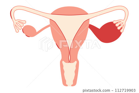 子宮內膜異位症、子宮和卵巢解剖圖的插圖 112719903