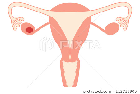 Illustrated illustration of ovarian cancer stage I, anatomical diagram of the uterus and ovaries 112719909