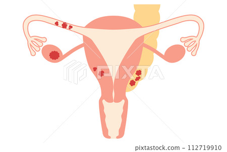 Illustrated illustration of ovarian cancer stage II, anatomical diagram of the uterus and ovaries Illustrated illustration of ovarian cancer stage II, anatomical diagram of the uterus and ovaries 112719910