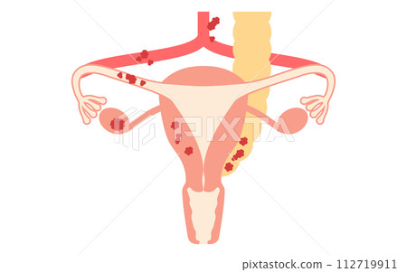 Illustrated illustration of ovarian cancer stage III, anatomical diagram of the uterus and ovaries 112719911