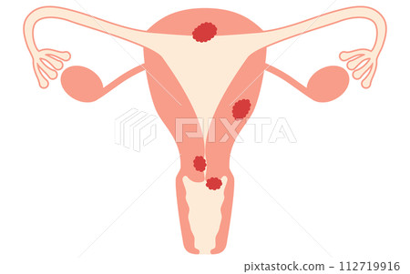 Illustrated illustration of uterine cancer, anatomical diagram of the uterus and ovaries Illustrated illustration of uterine cancer, anatomical diagram of the uterus and ovaries 112719916