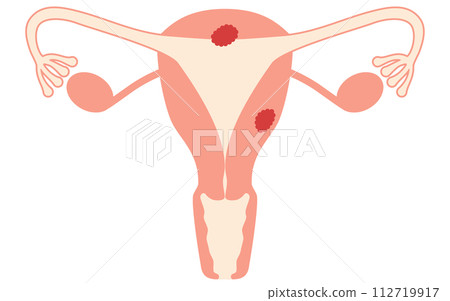 子宮癌圖解、子宮和卵巢解剖圖 112719917