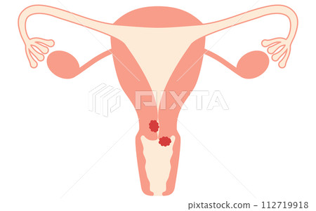 Illustrated illustration of cervical cancer, anatomical diagram of the uterus and ovaries Illustrated illustration of cervical cancer, anatomical diagram of the uterus and ovaries 112719918