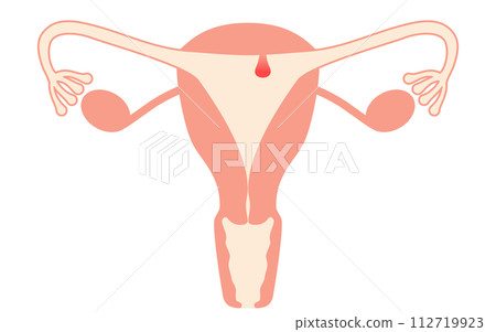 Illustrated illustration of endometrial polyps, anatomical diagram of the uterus and ovaries Illustrated illustration of endometrial polyps, anatomical diagram of the uterus and ovaries 112719923