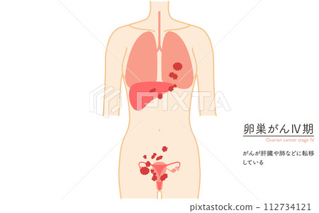 卵巢癌 IV 期圖解,子宮和卵巢的解剖圖 卵巢癌 IV 期圖解,子宮和卵巢的解剖圖 112734121