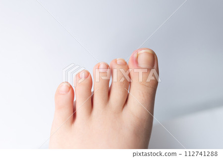 Close-up photo of an ingrown toenail, showing discomfort and potential pain. 112741288
