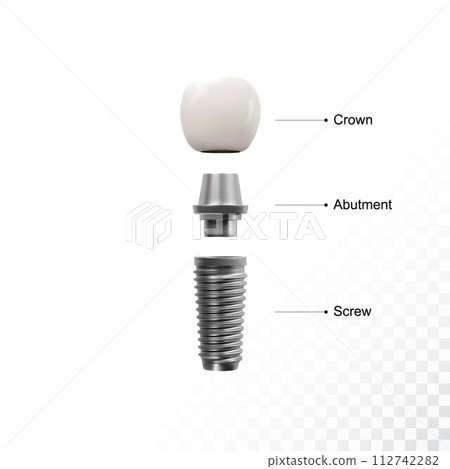 White tooth implant implant cut, healthy tooth or dental surgery. 112742282