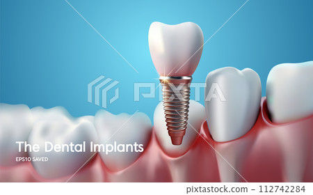 White tooth implant implant cut, healthy tooth or dental surgery. 112742284