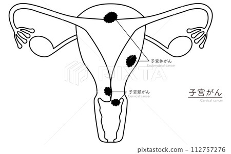 子宮癌圖解、子宮和卵巢解剖圖 112757276