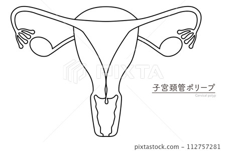 子宮頸息肉插圖、子宮和卵巢解剖圖 112757281