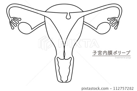 子宮內膜息肉插圖、子宮和卵巢解剖圖 112757282