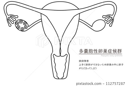 Illustrated illustration of polycystic ovary syndrome (ovulation disorder), anatomical diagram of the uterus and ovaries Illustrated illustration of polycystic ovary syndrome (ovulation disorder), anatomical diagram of the uterus and ovaries 112757287