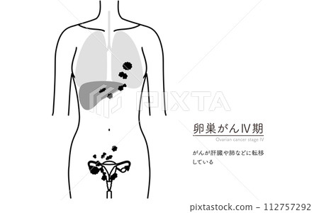 卵巢癌 IV 期圖解,子宮和卵巢的解剖圖 卵巢癌 IV 期圖解,子宮和卵巢的解剖圖 112757292