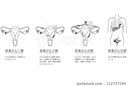 Illustrated illustration of ovarian cancer stage I, anatomical diagram of the uterus and ovaries 112757294