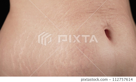 Woman showing stretch marks on abdomen after pregnancy. Natural body texture Woman showing stretch marks on abdomen after pregnancy. Natural body texture 112757614