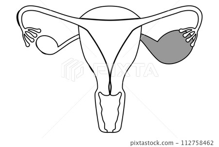 子宮內膜異位症、子宮和卵巢解剖圖的插圖 112758462
