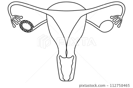 多囊性卵巢症候群(成熟障礙)插圖、子宮和卵巢解剖圖 多囊性卵巢症候群(成熟障礙)插圖、子宮和卵巢解剖圖 112758465