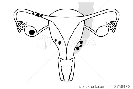 Illustrated illustration of ovarian cancer stage II, anatomical diagram of the uterus and ovaries 112758470