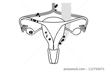 Illustrated illustration of ovarian cancer stage III, anatomical diagram of the uterus and ovaries 112758471