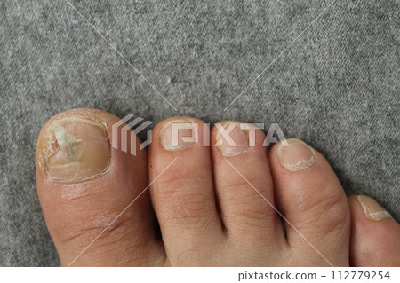 Damaged toenail plate close-up. Nail and skin diseases fungus Damaged toenail plate close-up. Nail and skin diseases fungus 112779254