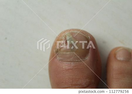 Fungal diseases of the nails and skin of the feet close-up. Podology and treatment options for nail plates. 112779256