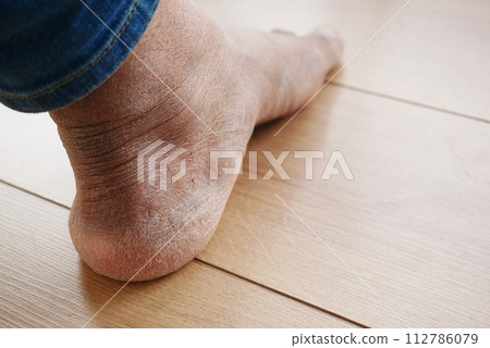 close up of young men dry feet close up of young men dry feet 112786079