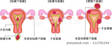 Uterine fibroid classification illustration 112792204